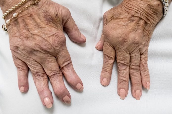Vitamin K2 shows promise for rheumatoid arthritis sufferers