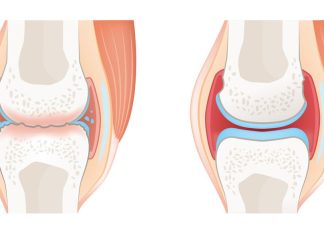 Rheumatoid Arthritis vs Osteoarthritis: Understanding the Key Differences and Similarities Rheumatoid Arthritis vs Osteoarthritis: Understanding the Key Differences and Similarities