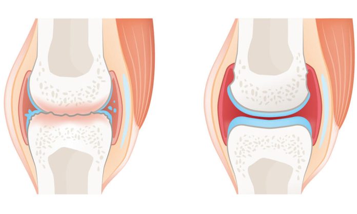 Rheumatoid Arthritis vs Osteoarthritis: Understanding the Key Differences and Similarities