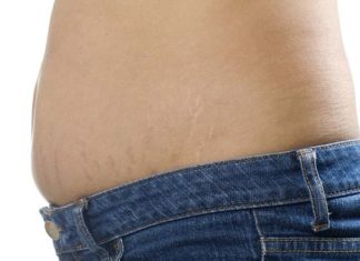 Top 5 Natural Stretch Marks Treatments You Must Know Top 5 Natural Stretch Marks Treatments You Must Know