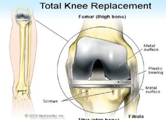 Total knee arthroplasty – Is It Worth for stiff and sore knee joints? Total knee arthroplasty - Is It Worth for stiff and sore knee joints?