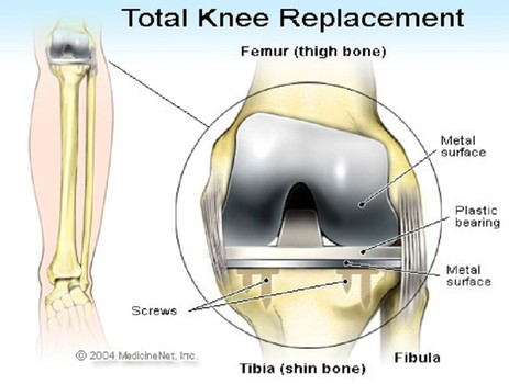 Total knee arthroplasty - Is It Worth for stiff and sore knee joints?