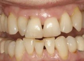 High blood sugar can cause gum disease in diabetics High blood sugar can cause gum disease in diabetics