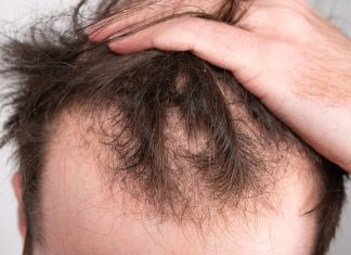 New cure for male pattern baldness may be pulling hairs New cure for male pattern baldness may be pulling hairs
