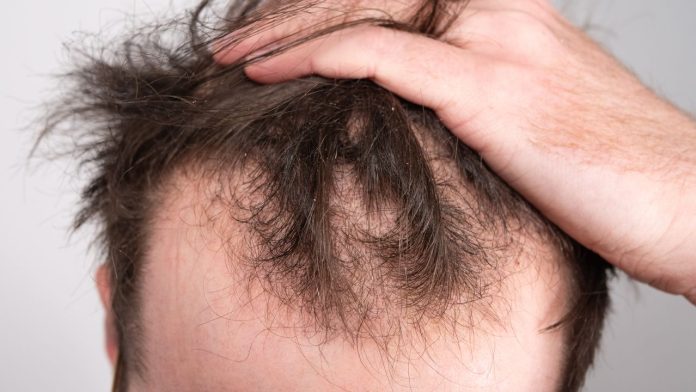 New cure for male pattern baldness may be pulling hairs